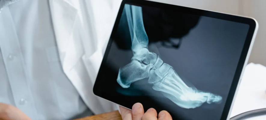 Osteoporosi: sintomi e trattamenti Osteoporosi: sintomi e trattamenti