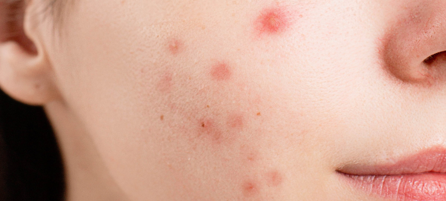 Cicatrici acne come prevenirle e curarle