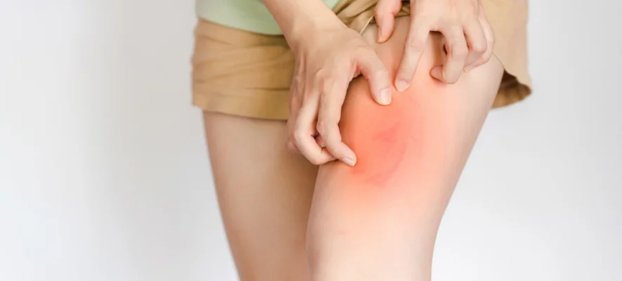 Dermatite in vacanza Dermatite in vacanza